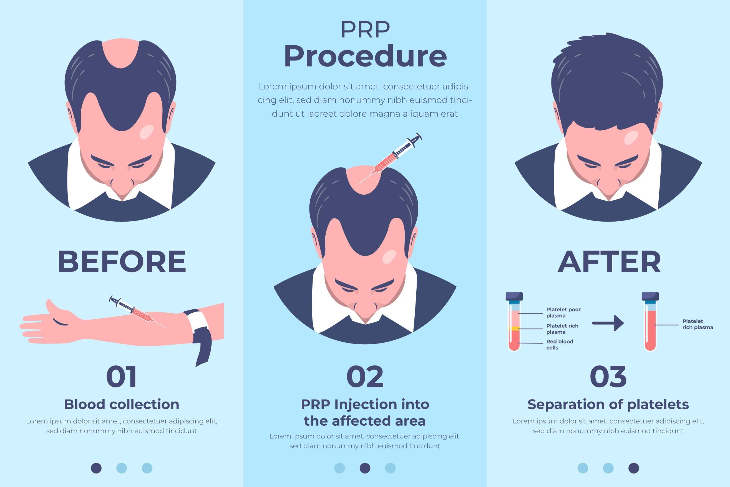 How PRP Hair Transplant Works